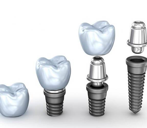 Replace missing teeth in Exeter - Dental Implants