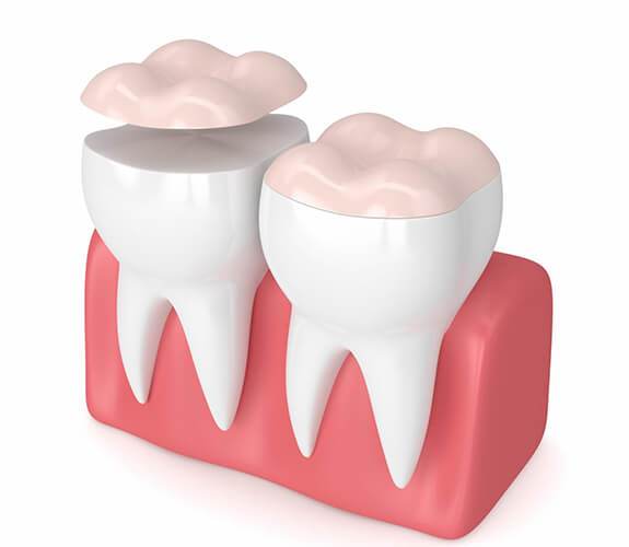 Dental Onlays