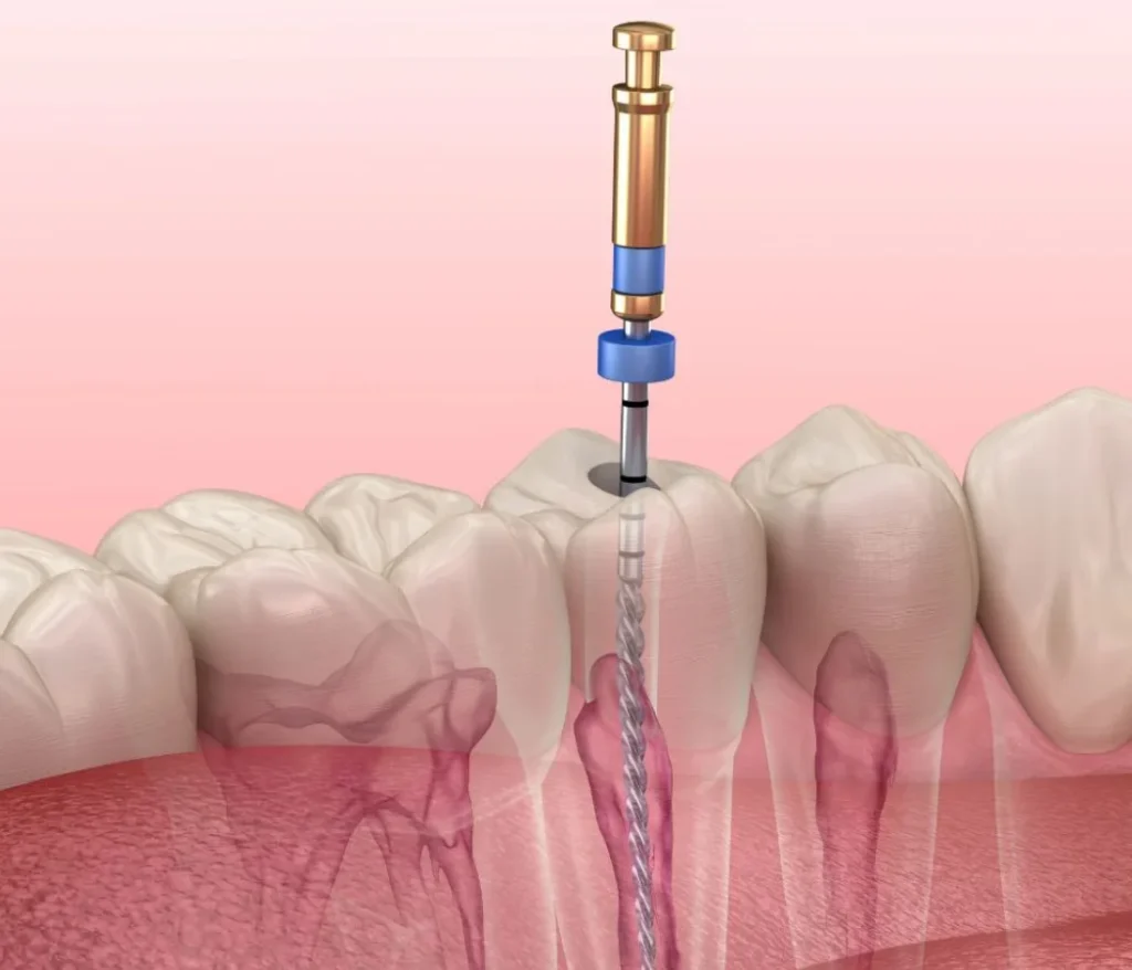 root canal