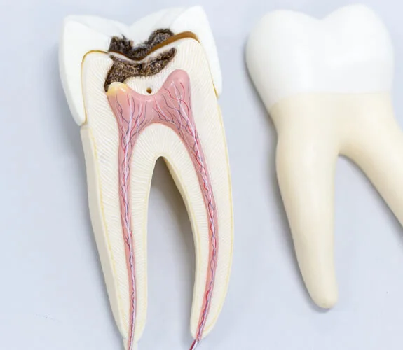 root canal